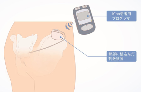 仙骨神経電気刺激
装置植え込み手術