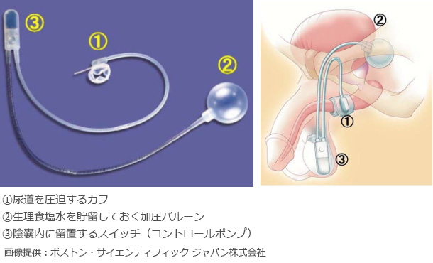 男性尿失禁に対する人工括約筋埋込み術