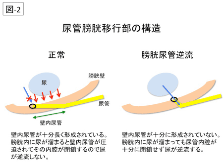 膀胱尿管逆流