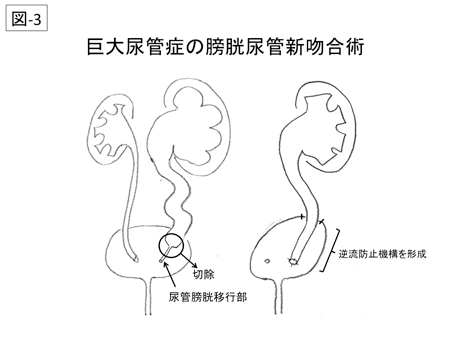 巨大尿管症