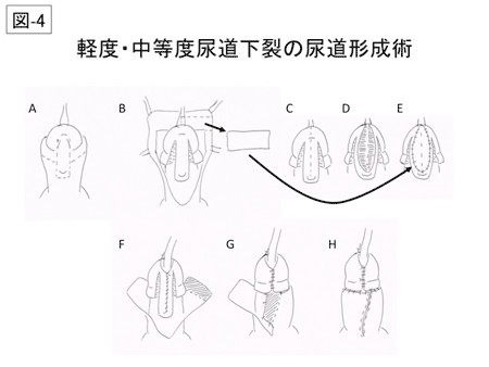 尿道形成術