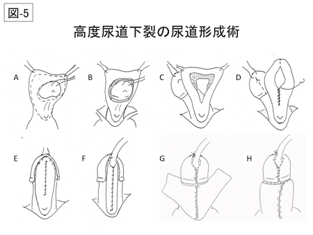 尿道形成術