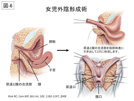 女児性分化疾患に対する外陰形成術