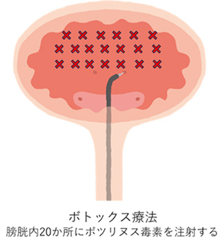 ボトックス療法（ボツリヌス毒素膀胱内注入療法）