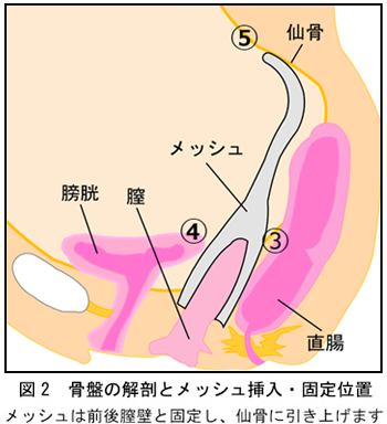 図２ 骨盤の解剖とメッシュ挿入・固定位置